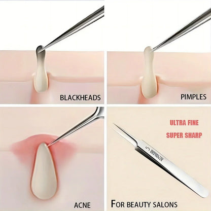 Precision Acne Removal Tweezers™