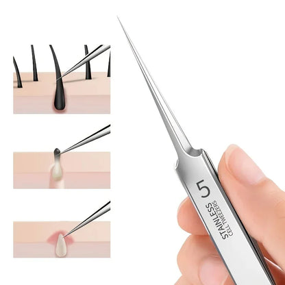 Precision Acne Removal Tweezers™